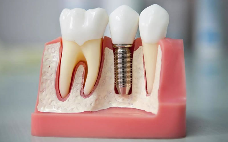 İmplant Diş Tedavisi