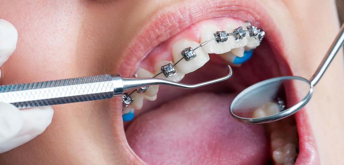 Ortodonti İle İmplant Yeri Hazırlama